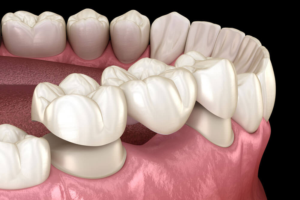 Dental bridge of 3 teeth over molar and premolar.