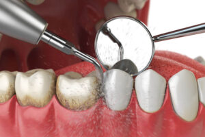 Professional teeth cleaning