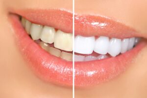 woman teeth before and after whitening