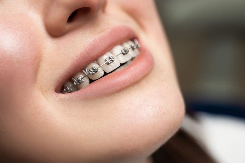 Braces For Young Kids Might Not Always Be Best : NPR